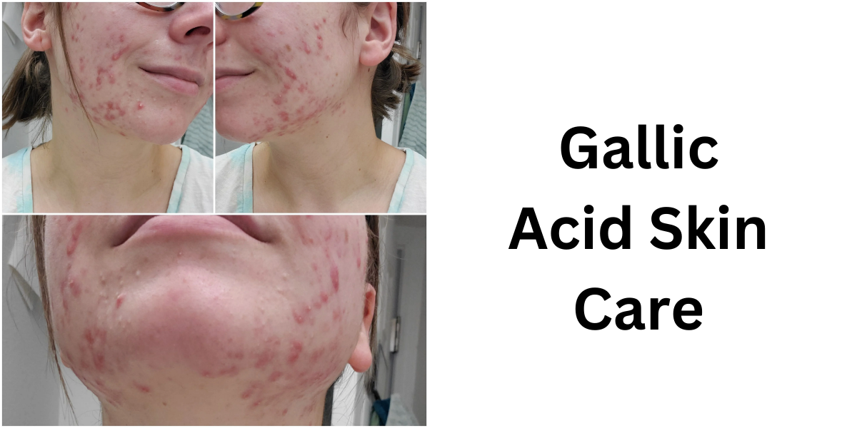 gallic acid skin care